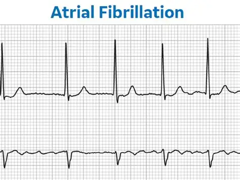 A fib ECG