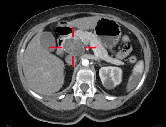 CT image showing Pancreatic CA